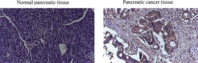 Review of Immunohistochemistry Biomarkers in Pancreatic Cancer Diagnosis